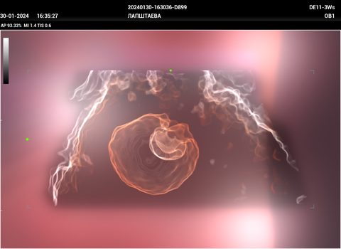 Гинекология, 3D, ранний срок: снимок с Mindray Imagyn I9