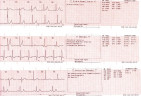 Пример распечатки ЭКГ кардиографа Fukuda FX-7102